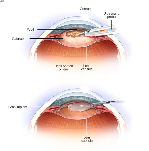 Cataract Surgery Photo